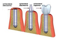 Имплантация зубов